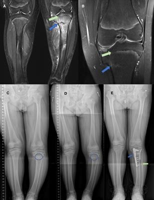 Case report: A rare Salter–Harris V metaphyseal fatigue fracture of the knee in an adolescent patient with obesity